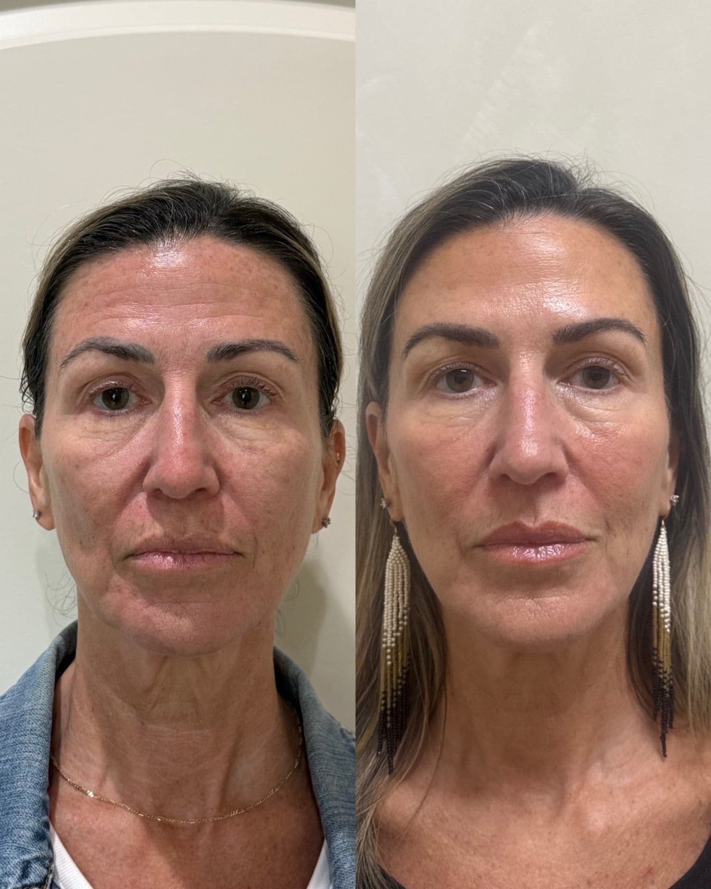 Botox & Wrinkle Relaxers treatment at I Love My Look