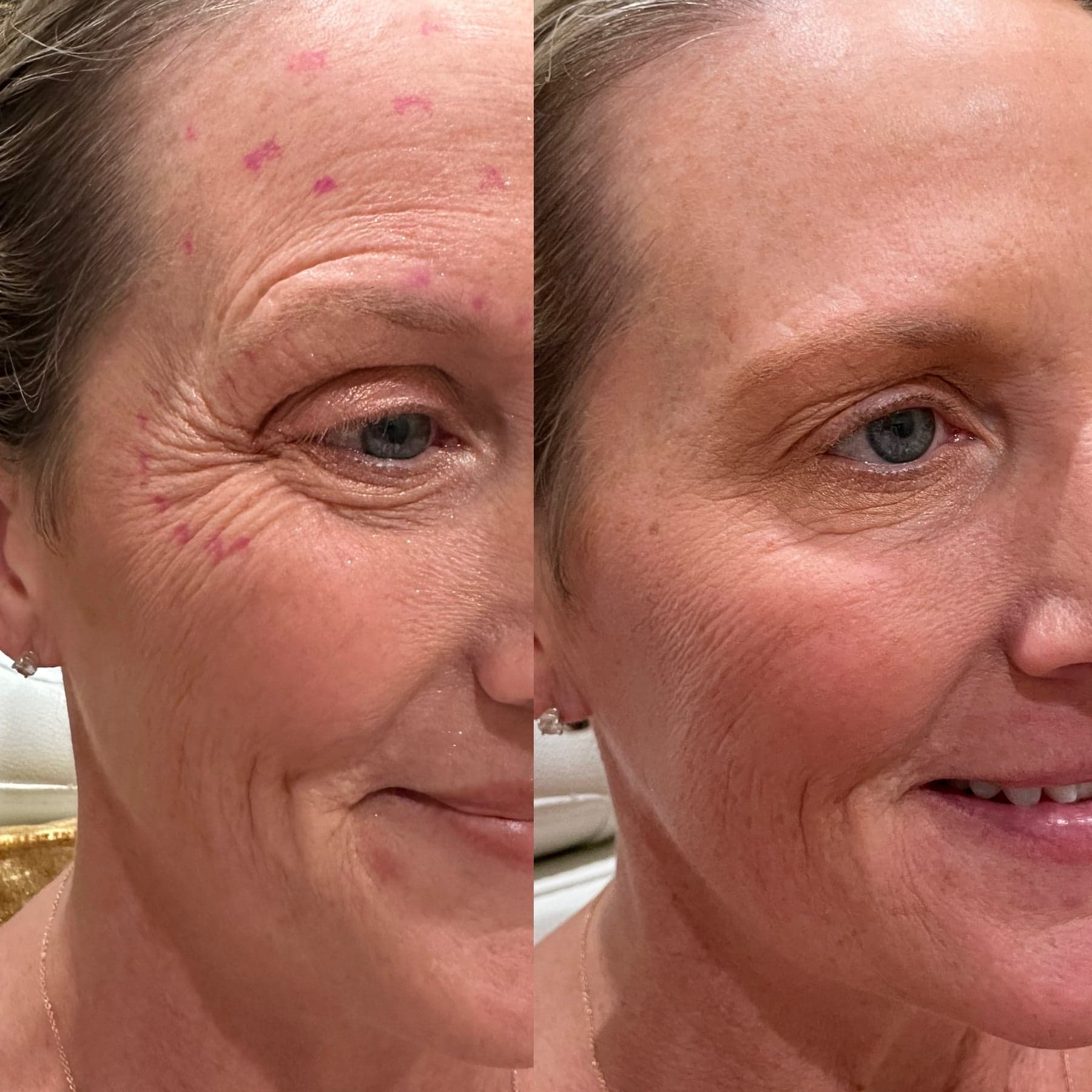 Botox before & after 2