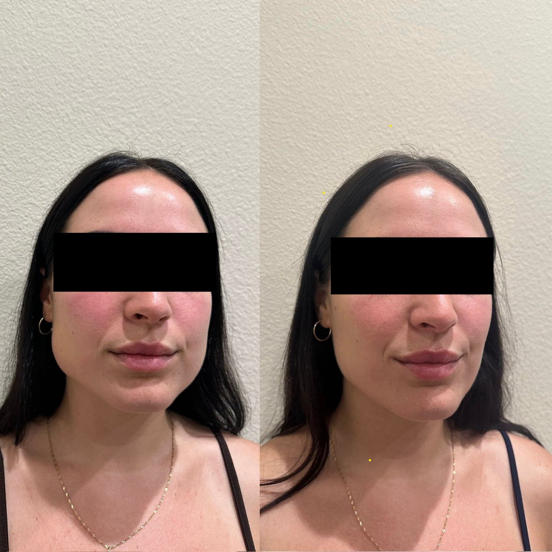 Botox before & after 3