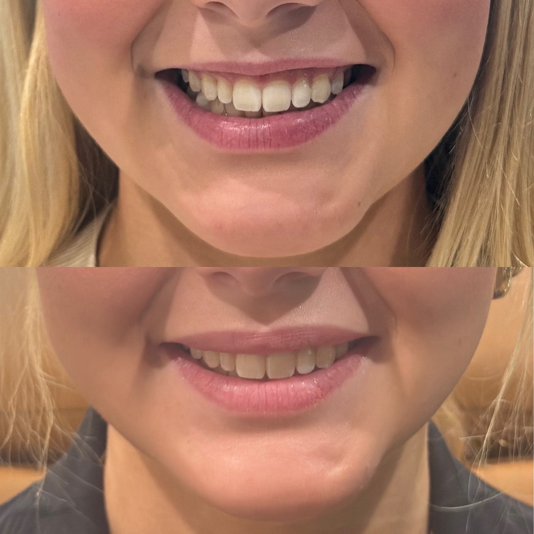 Lip flip before & after