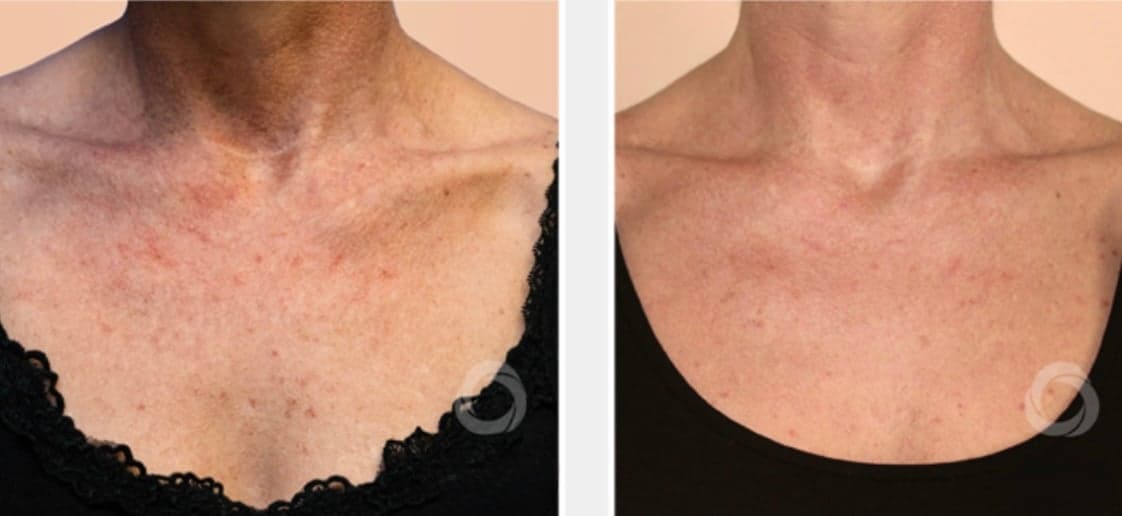 Chemical peel before & after 1