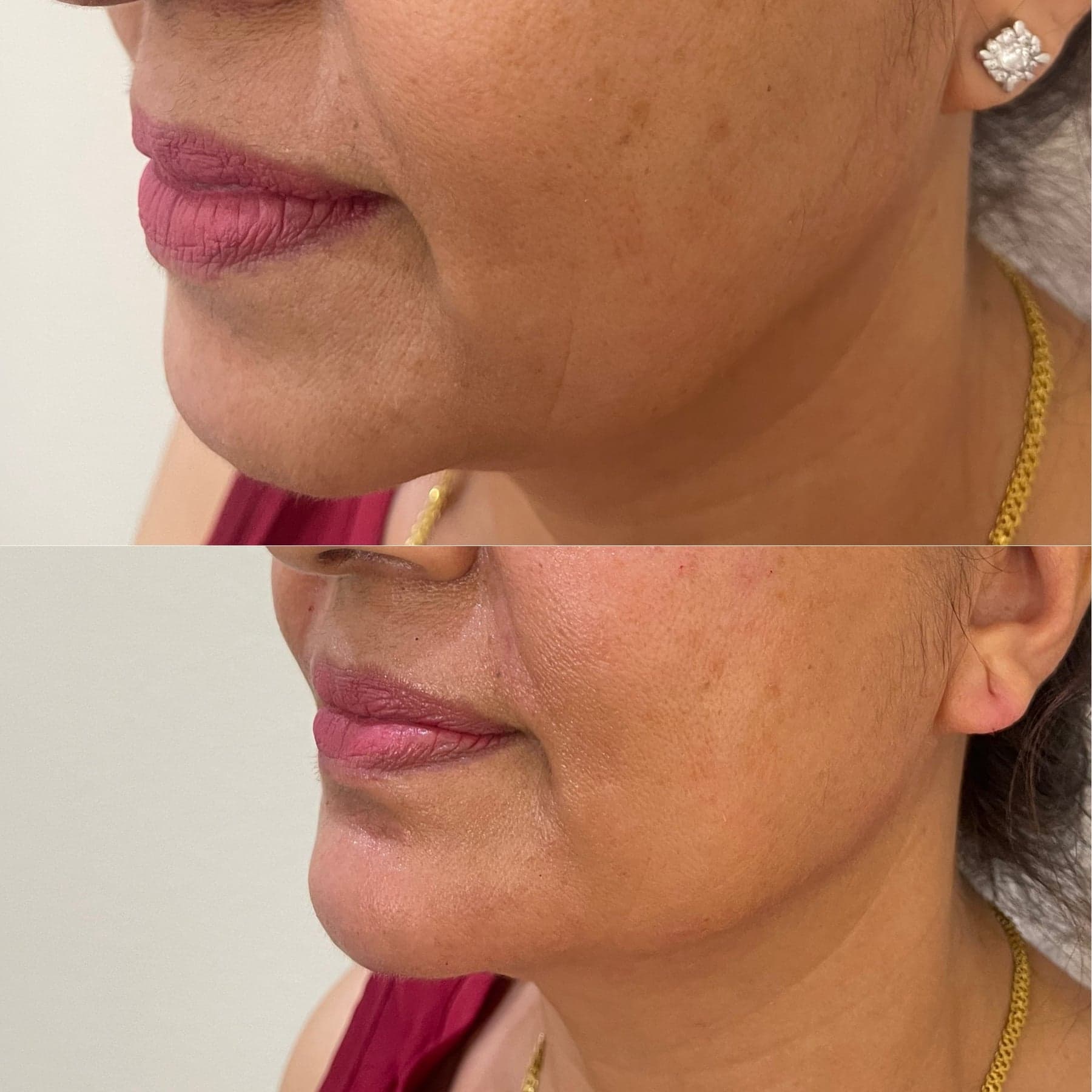 Dermal Fillers & Regenerative Volume treatment at I Love My Look