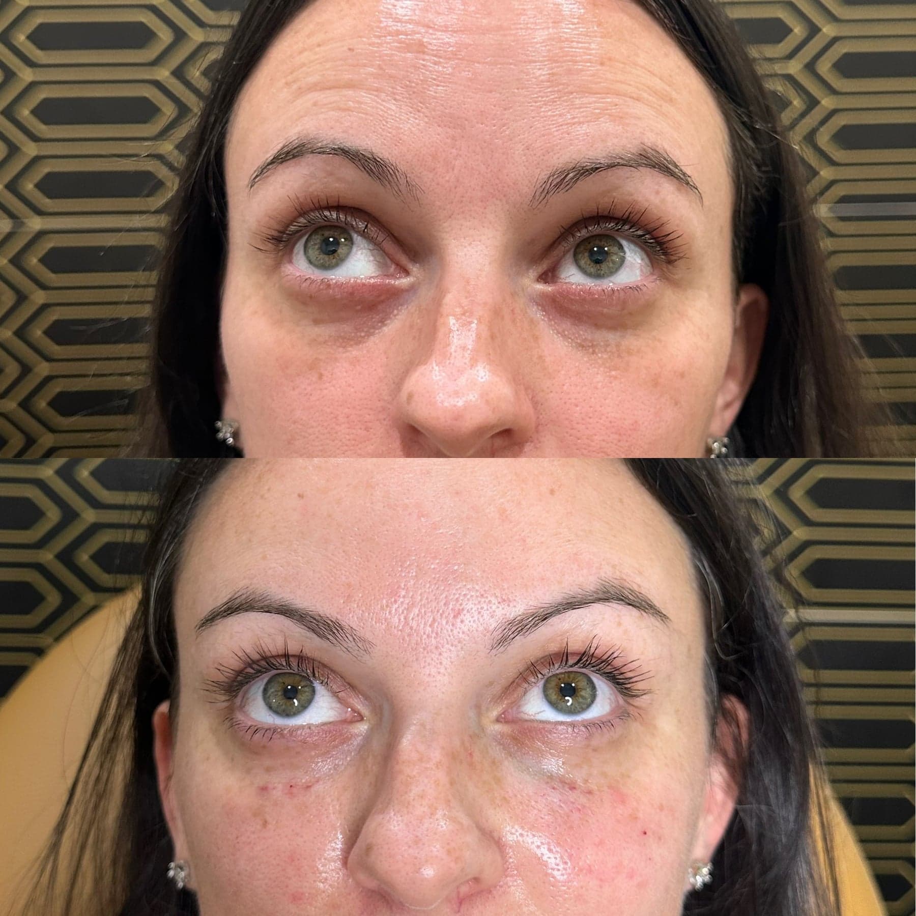 Under-Eye PRF & EZGel treatment at I Love My Look
