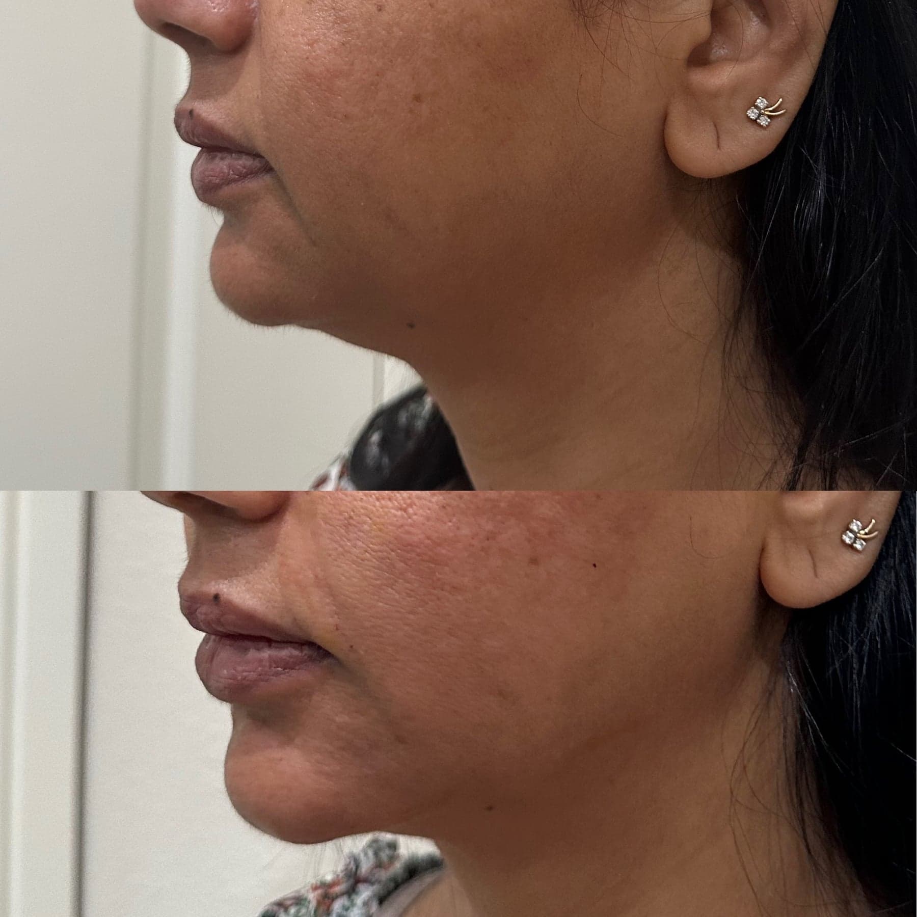 Dermal filler before & after 2