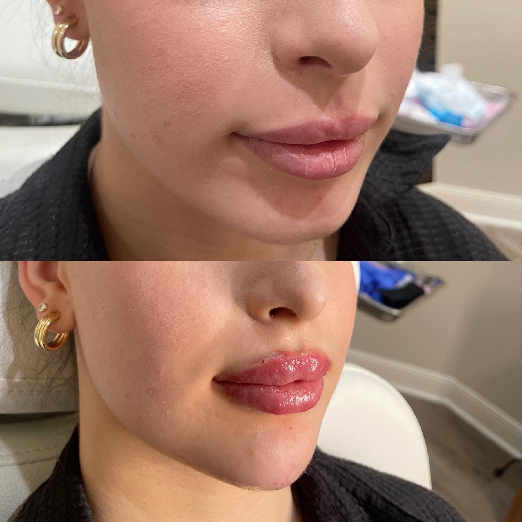 Dermal filler before & after 3