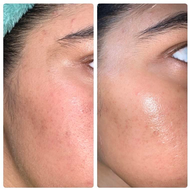 Dermaplane Precision Exfoliation treatment at I Love My Look