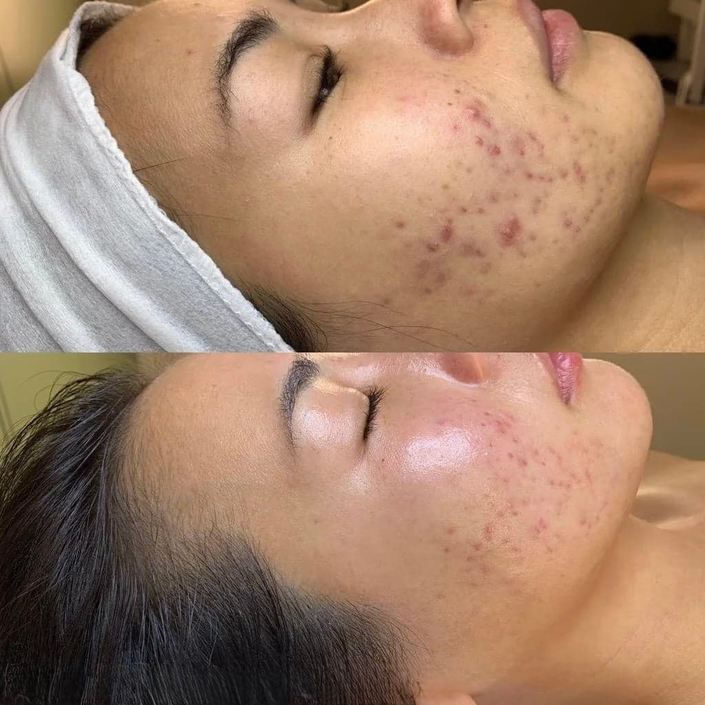 DMK Enzyme Therapy before & after 1