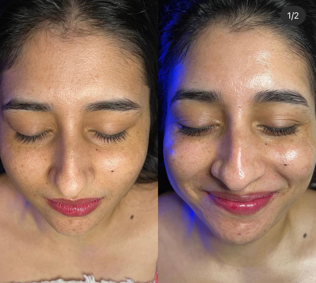 Hydrafacial Deep Cleansing & Hydration treatment at I Love My Look
