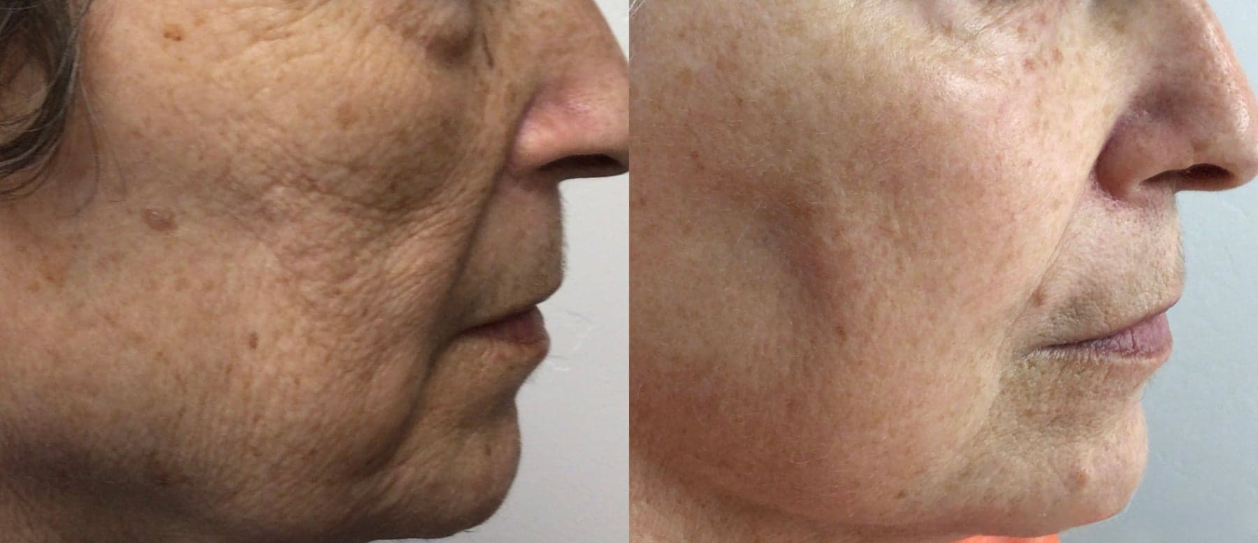 IPL Photofacial Skin Tone Correction treatment at I Love My Look