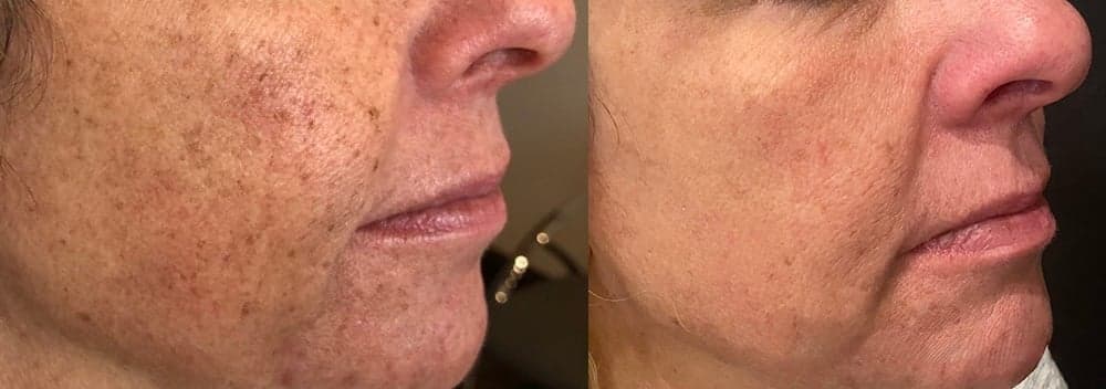 IPL photofacial before & after 2