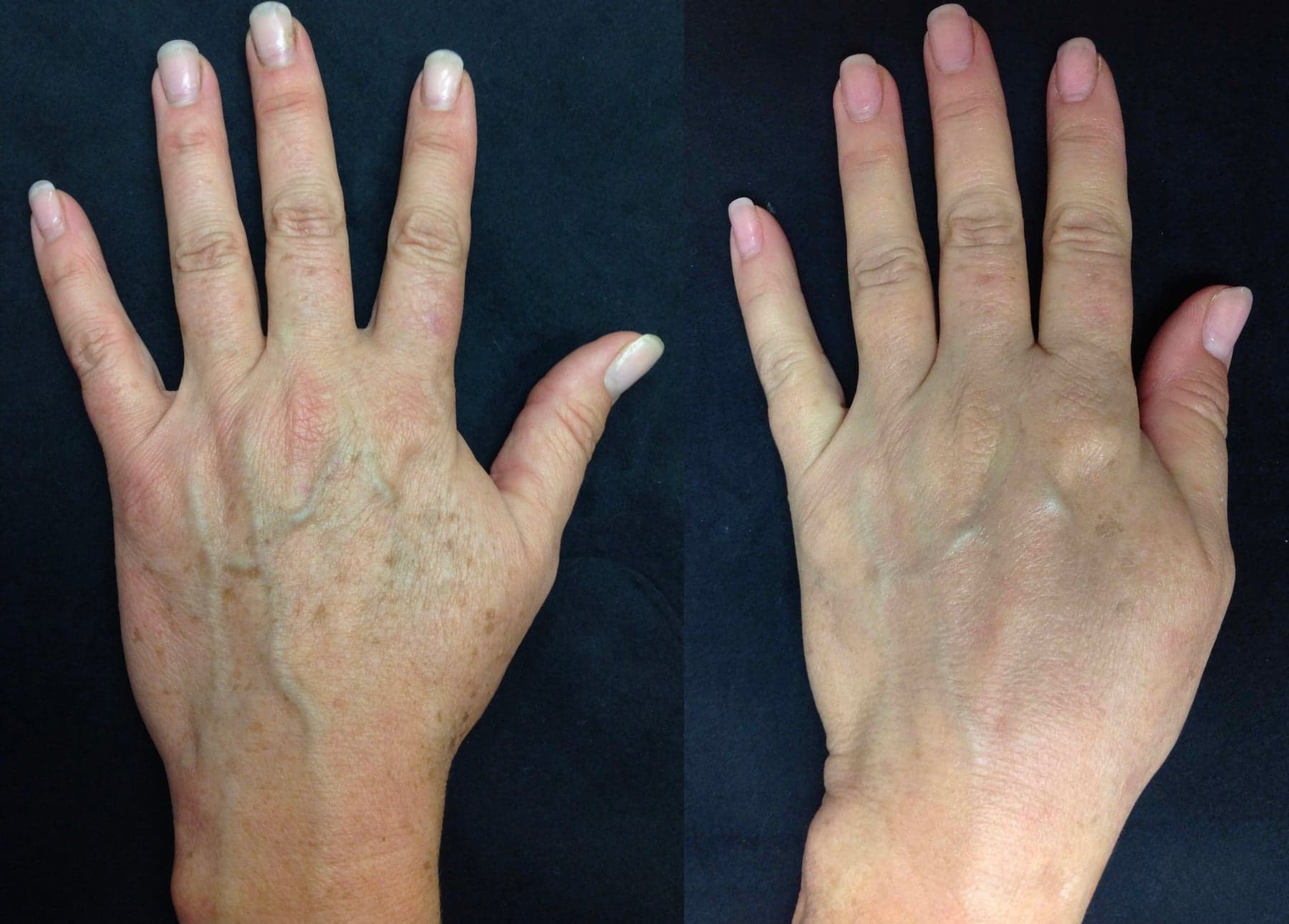 IPL photofacial before & after 3