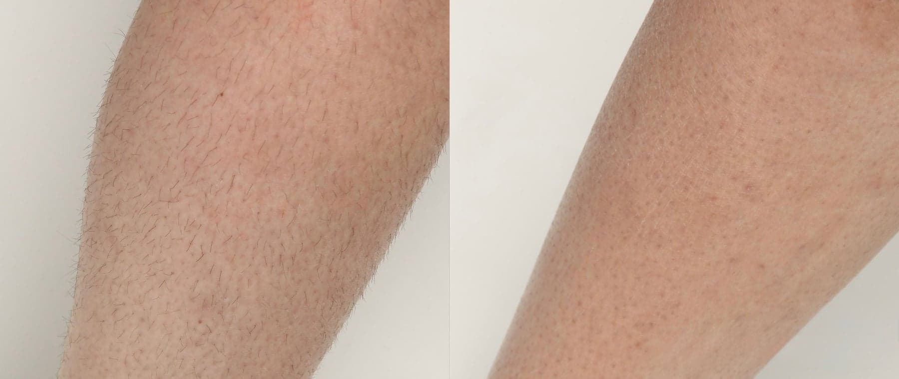 Laser hair removal before & after 1