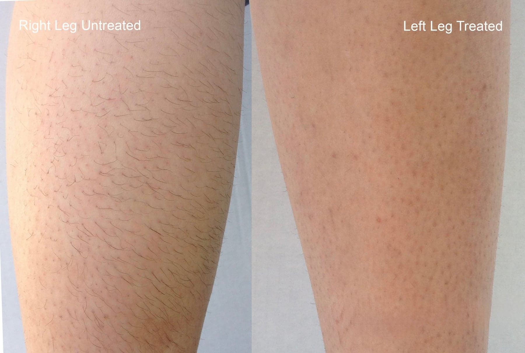 Laser hair removal before & after 2