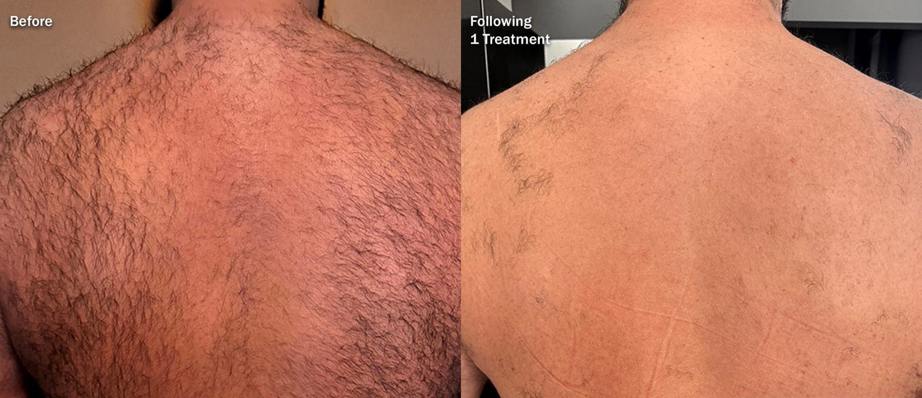 Laser hair removal before & after 3