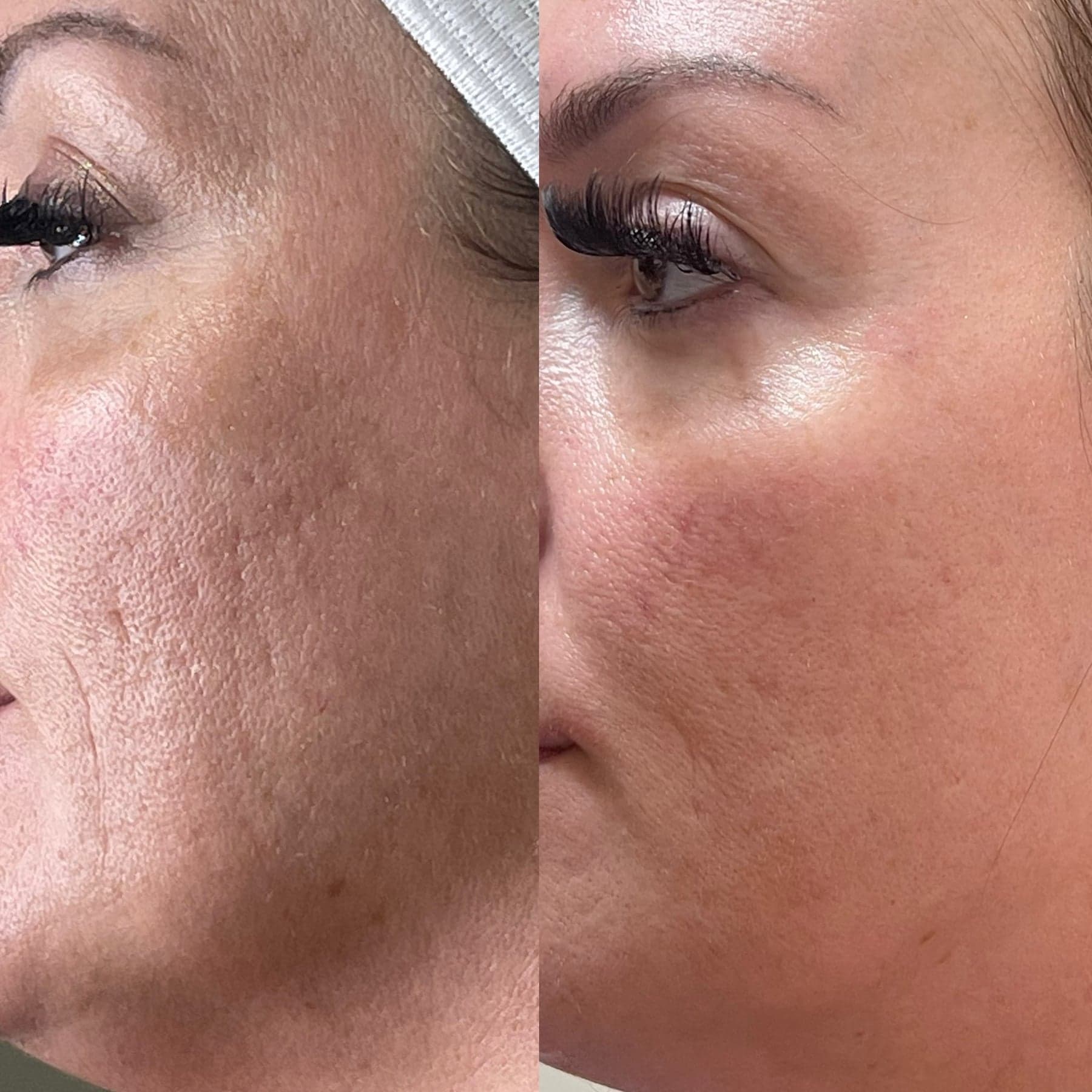Microneedling Skin Renewal treatment at I Love My Look
