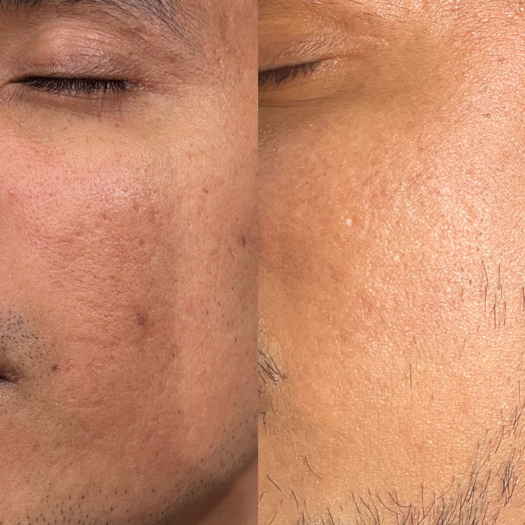 Microneedling before & after 2