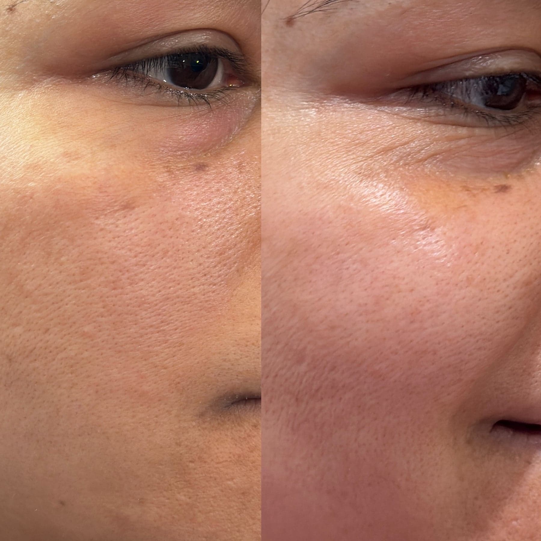 Microneedling before & after 3