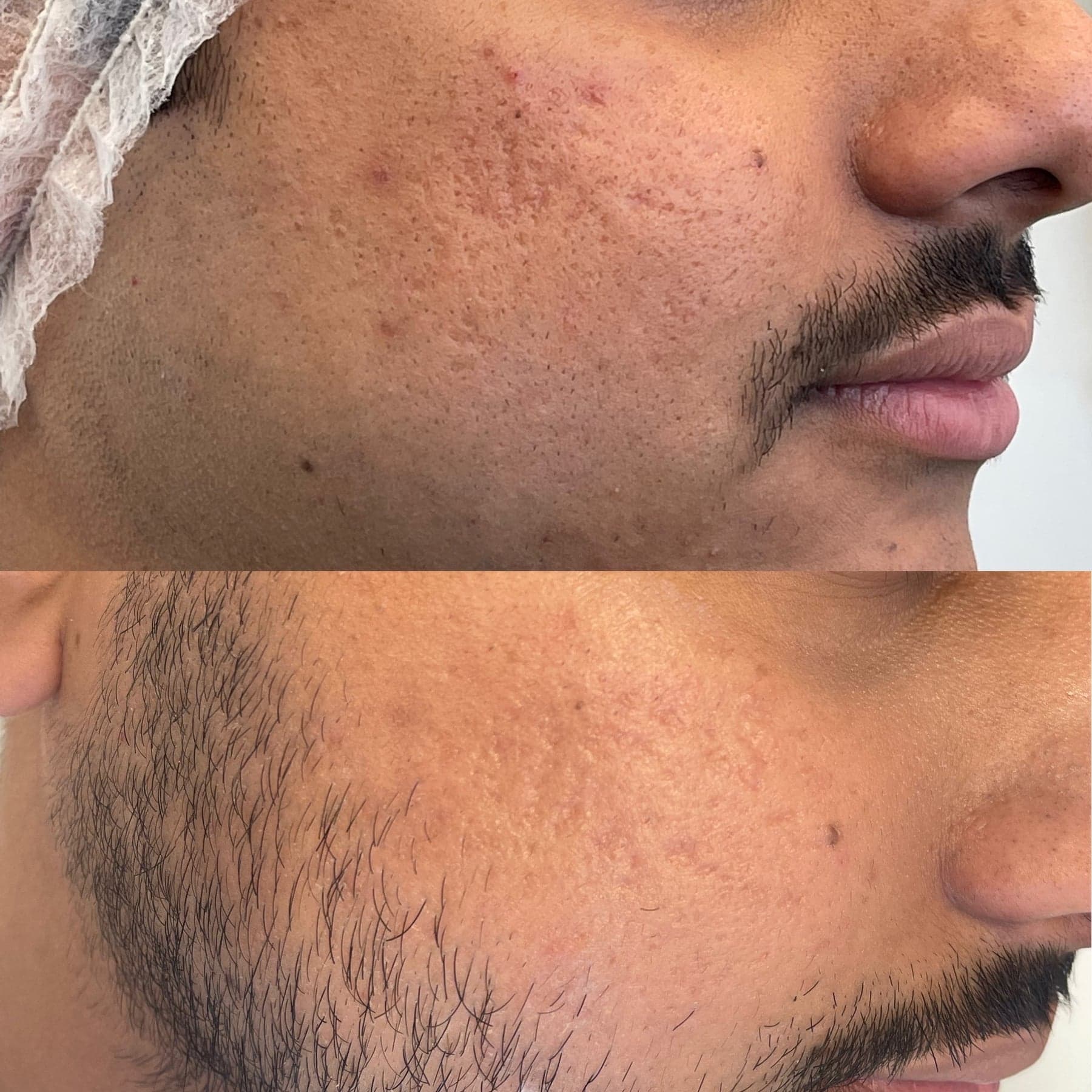 Microneedling before & after 4