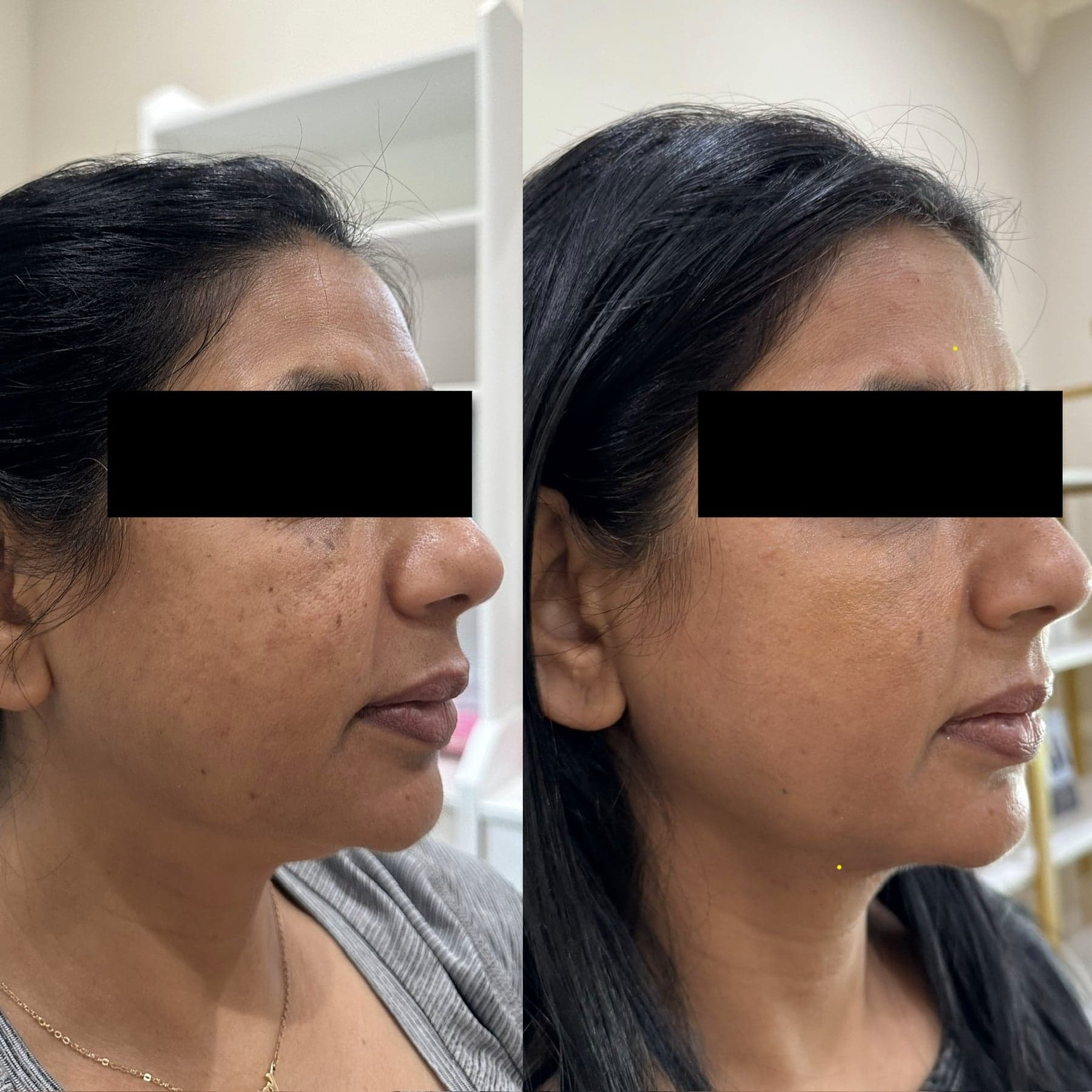 Morpheus8 Skin Tightening treatment at I Love My Look