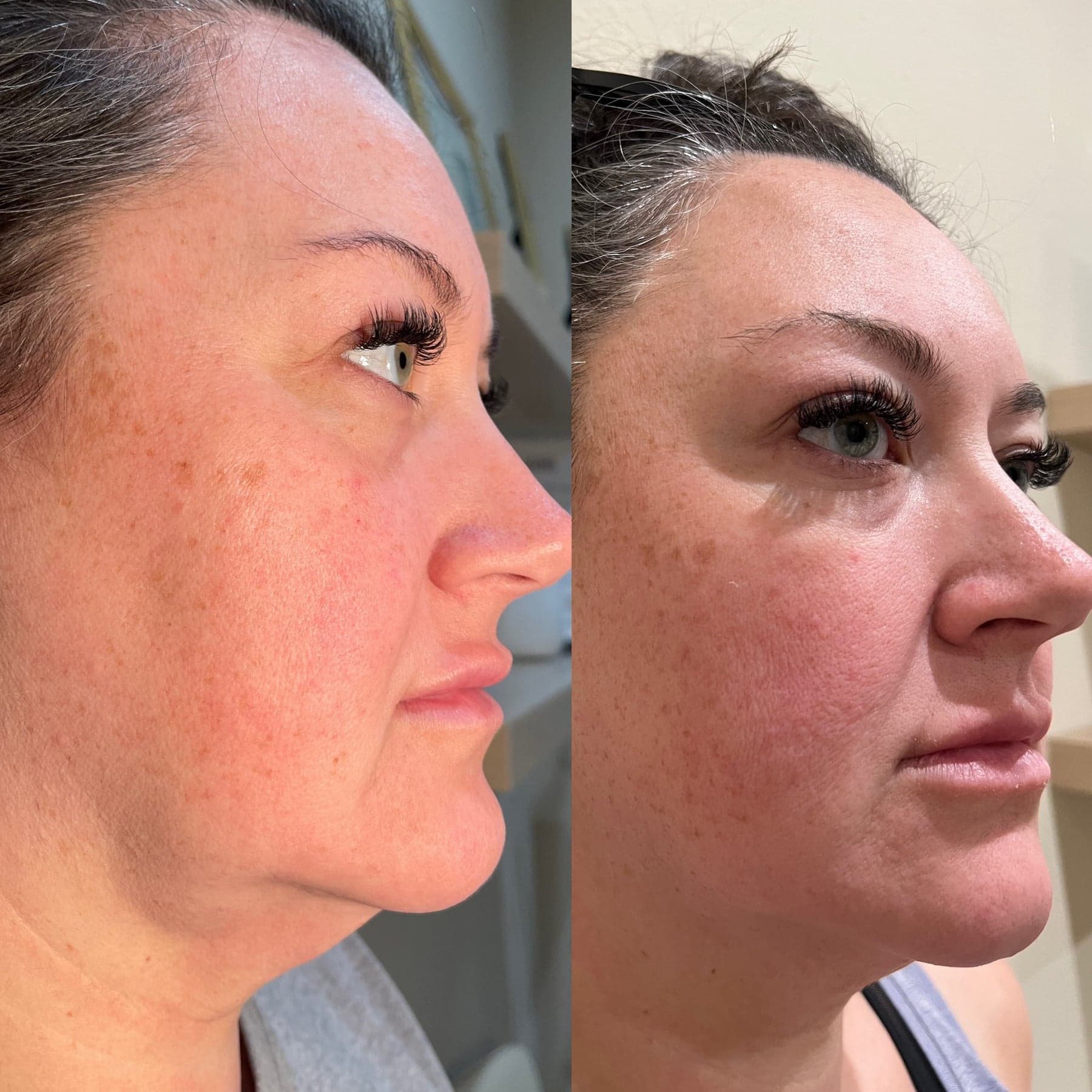 Morpheus8 before & after 2