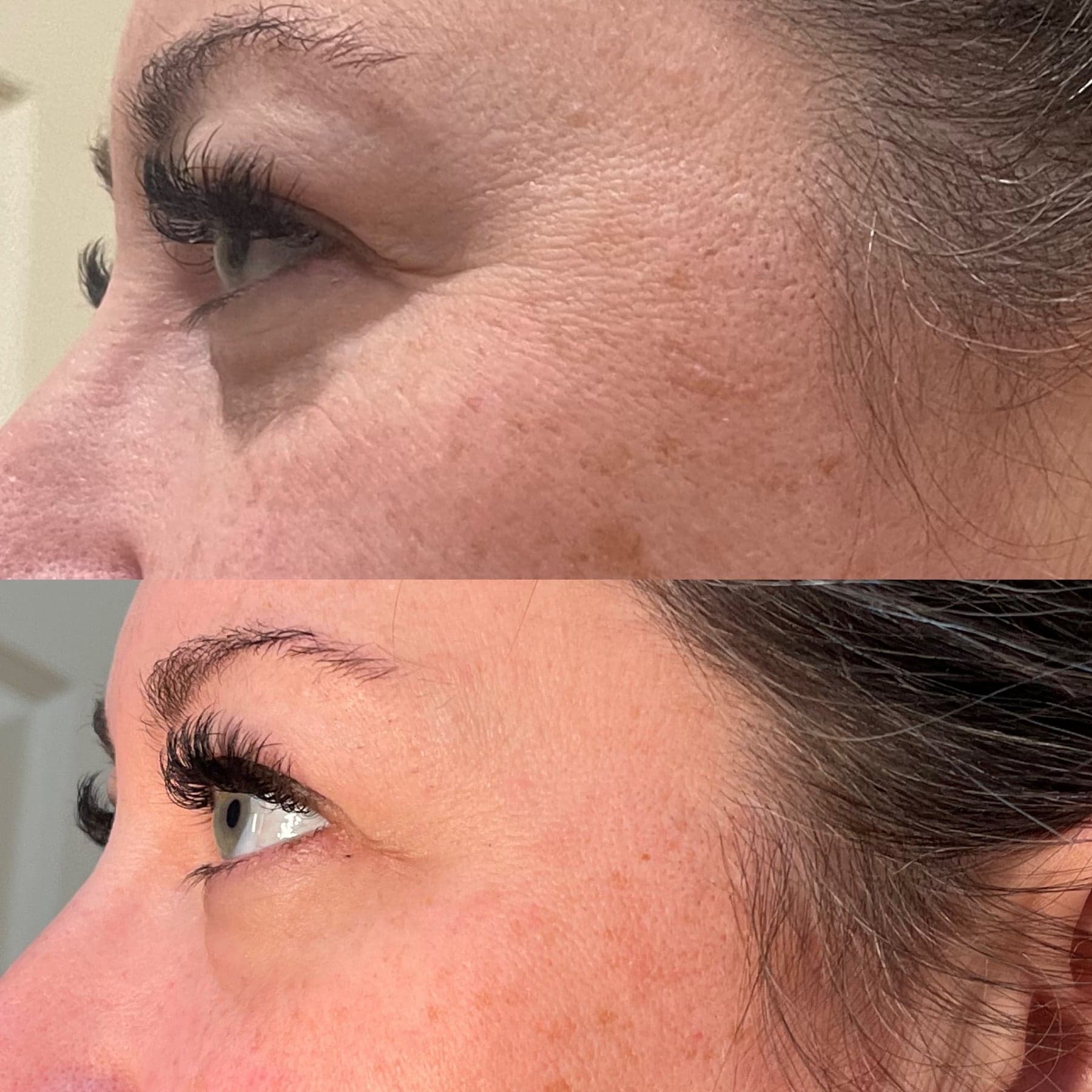 Morpheus8 before & after 3