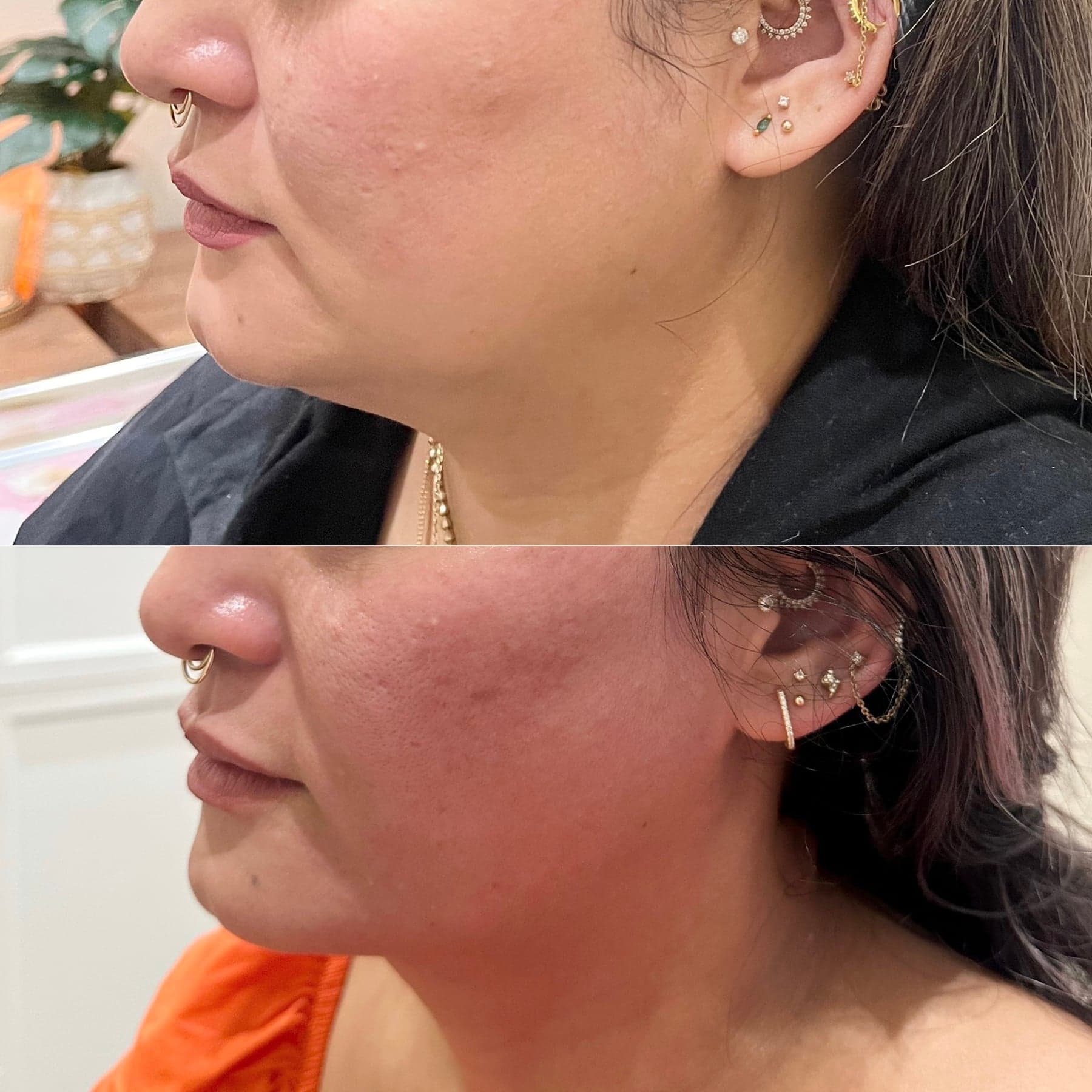 Morpheus8 before & after 4