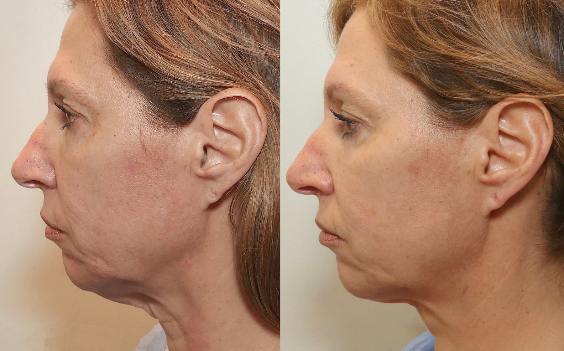 Morpheus8 before & after 5