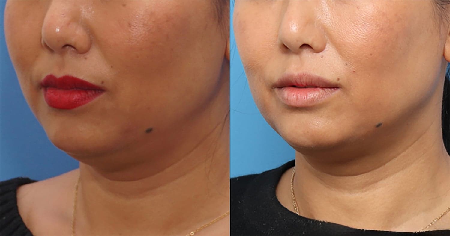 Morpheus8 before & after 6