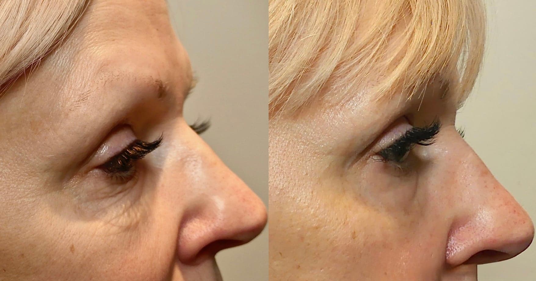 Morpheus8 before & after 7
