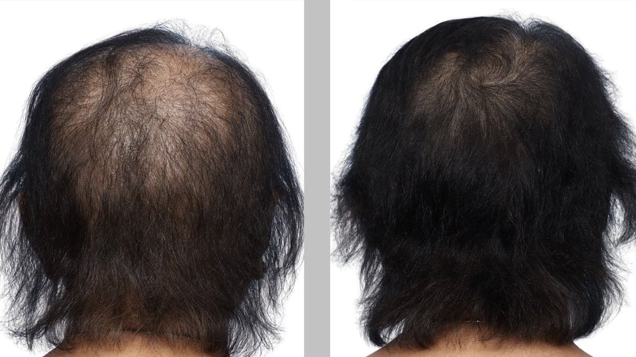 PRP & Exosome Hair Restoration treatment at I Love My Look