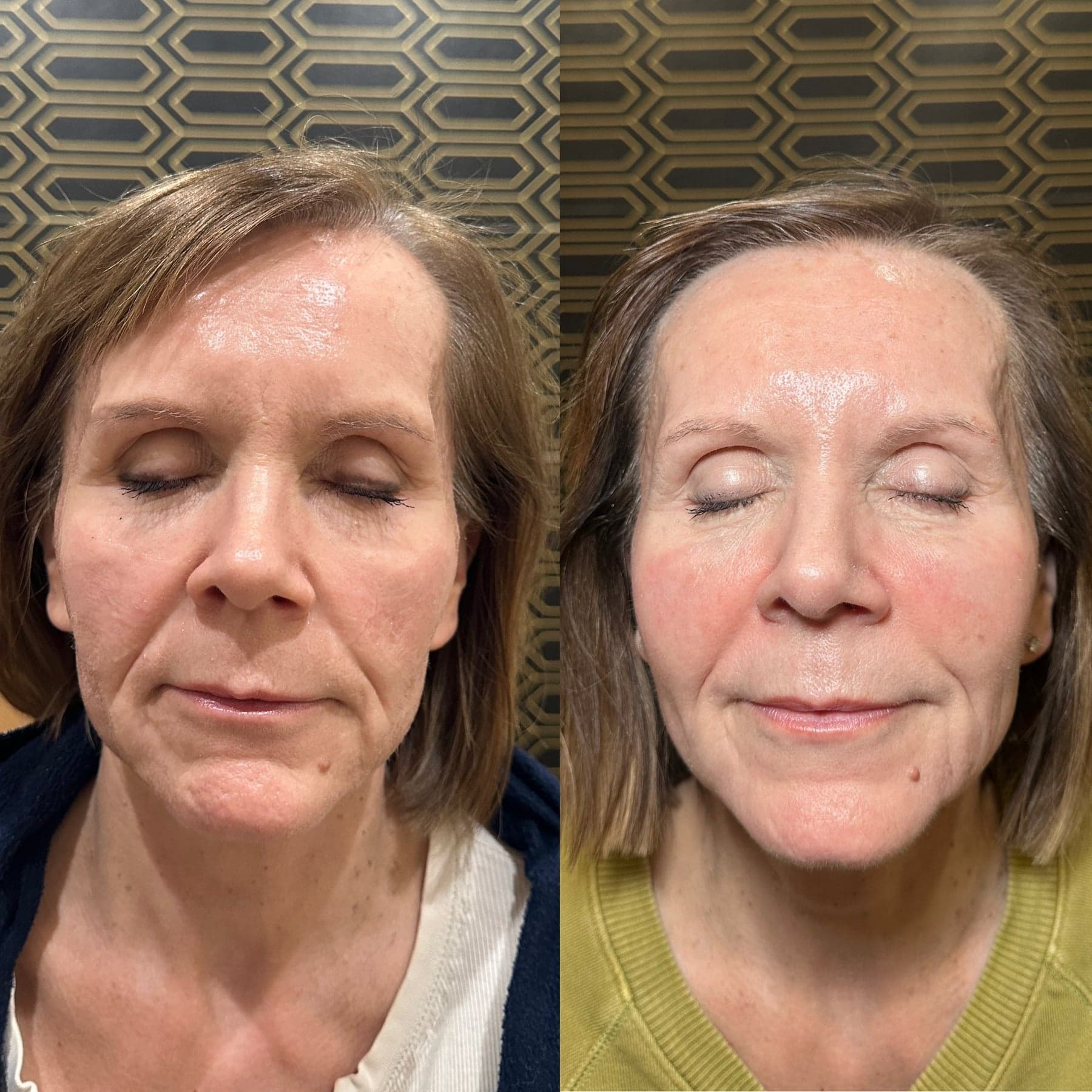 Sculptra before & after 1