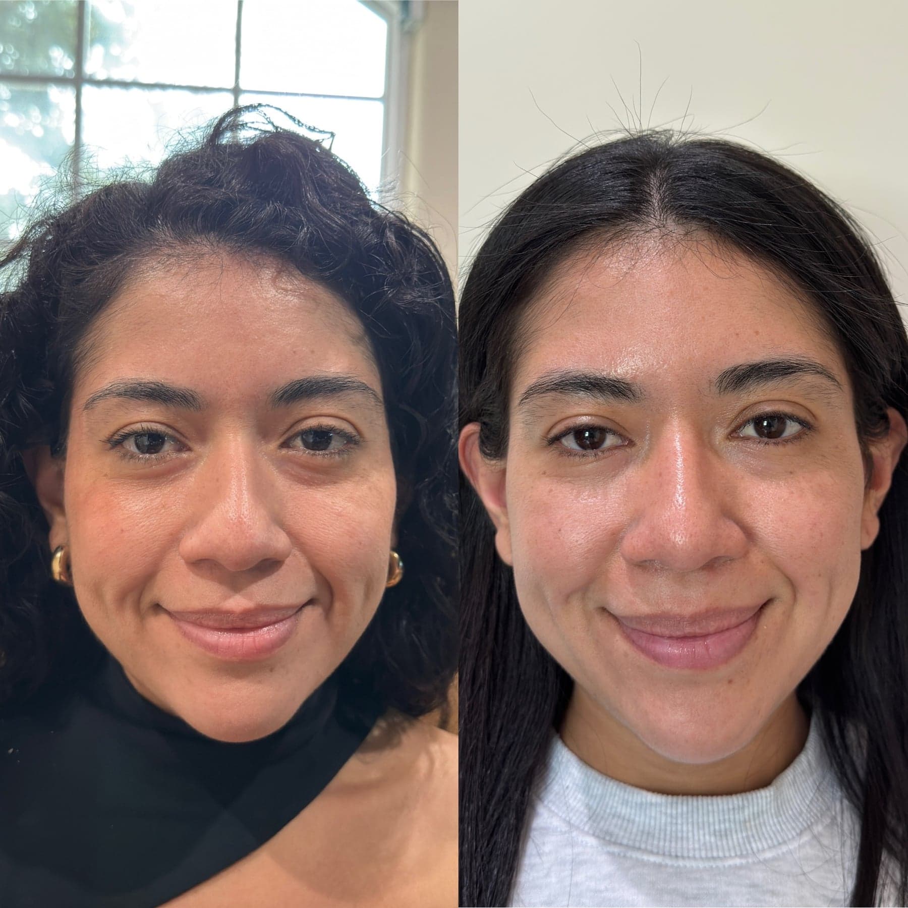Sculptra before & after 2
