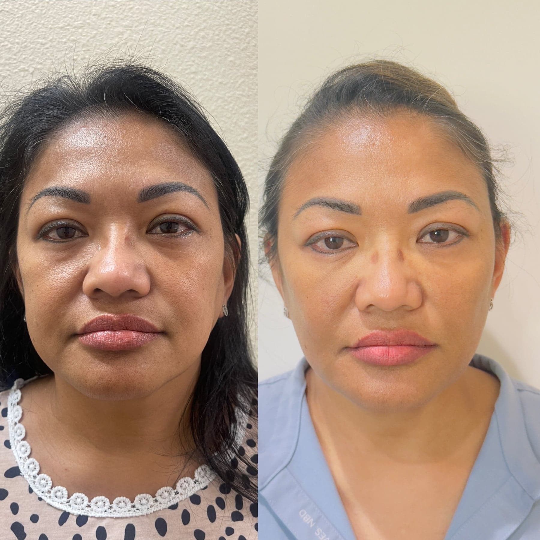Sculptra before & after 3