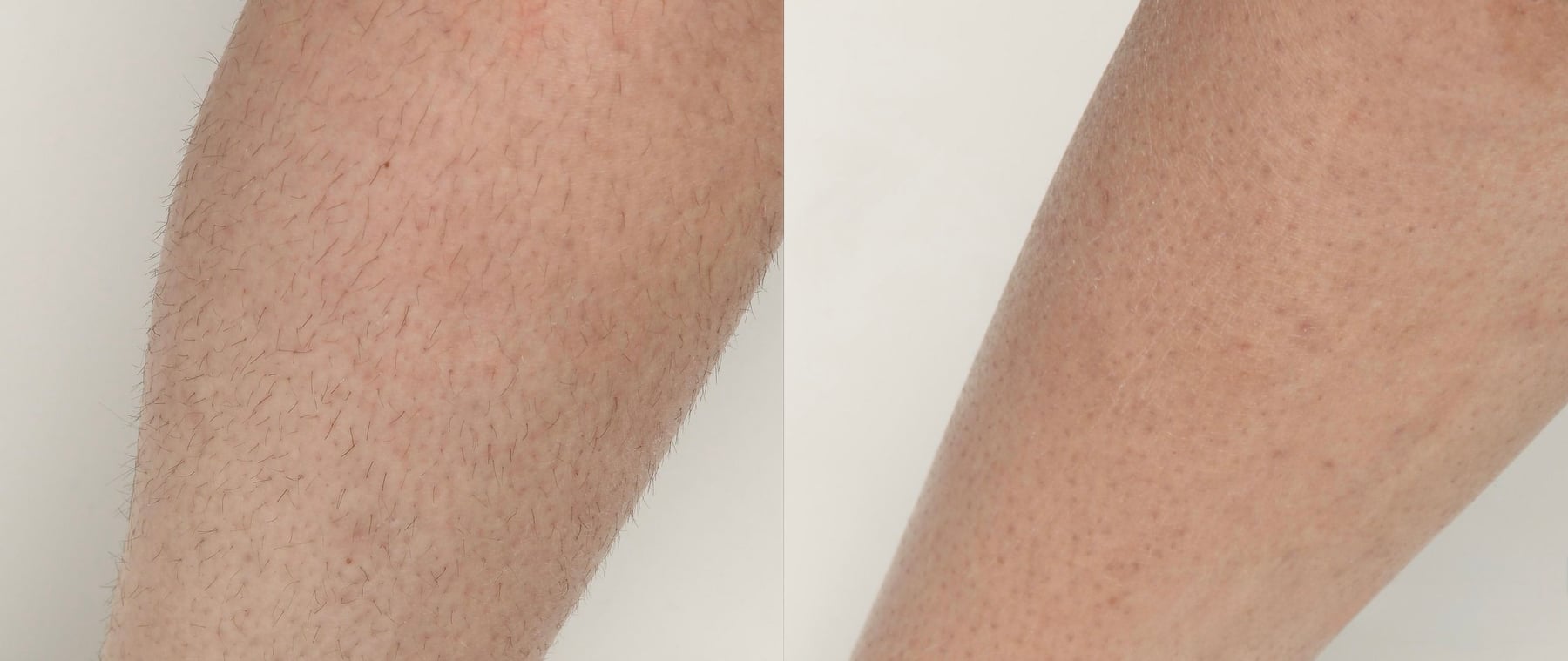 An ILML laser hair removal client’s legs before treatment on the left and after treatment on the right